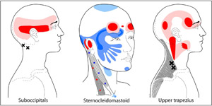 Trigger Points in neck